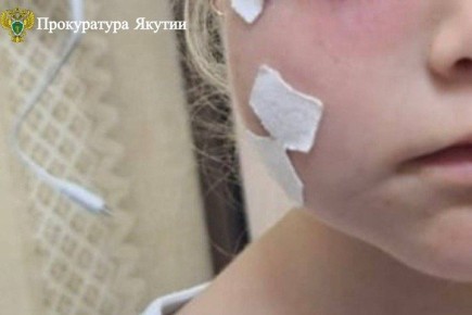 70 тысяч за испуг и раны. В Нерюнгри бродячая собака напала на маленькую трехлетнюю девочку, оставив ей рану от зубов на щеке